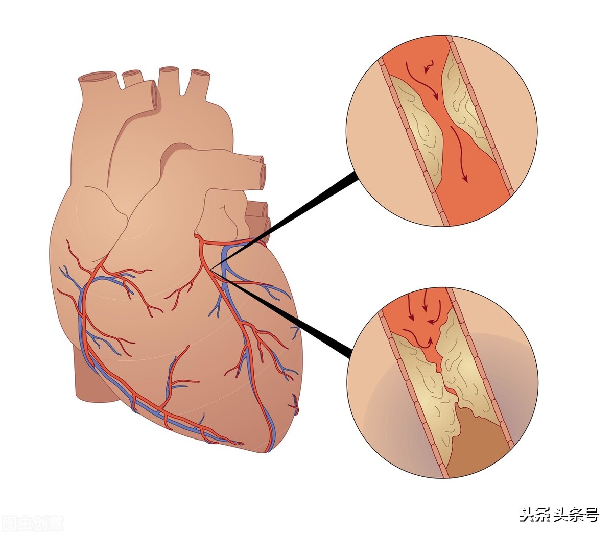 急性心肌梗死血管全部堵塞怎么办,心血管堵塞60%严重吗