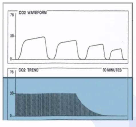 李娟教授：呼气末二氧化碳分压监测的临床应用