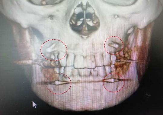 女司机下巴撞护栏情况,女司机撞栏杆下巴脱臼