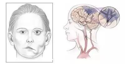 眼肌痉挛的新疗法,眼痉挛特效药