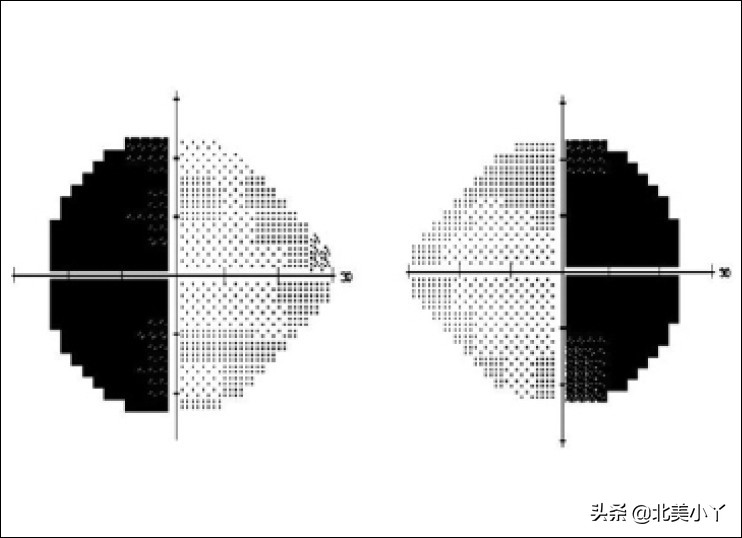小丫说医｜一类影响全身的特殊脑瘤——“蝶鞍邂逅瘤”