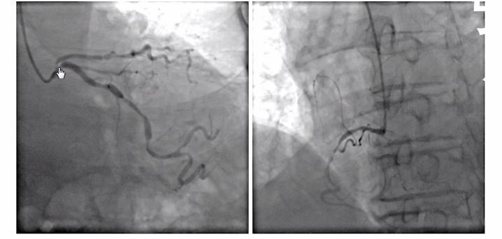 冠心病合并慢阻肺怎么治,85岁老人冠心病适合支架治疗吗