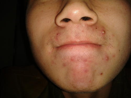 下巴螨虫白色小颗粒,下巴有个硬疙瘩是螨虫引起的么