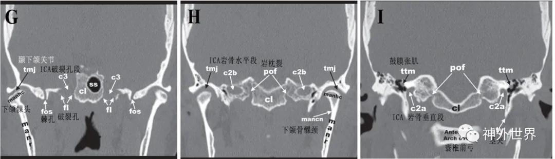 颅底骨折合并脑脊液漏伤情鉴定,颅底骨折伴脑脊液漏右眼眶骨折