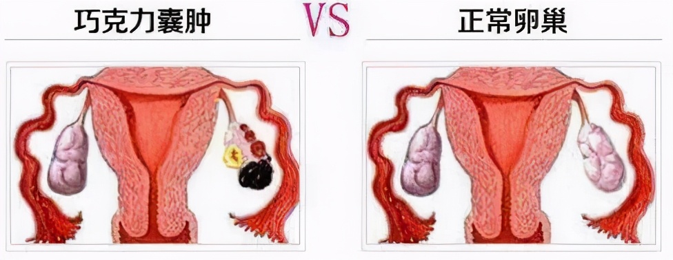 痛经是巧克力囊肿引起的吗,卵巢巧克力囊肿会引起痛经吗