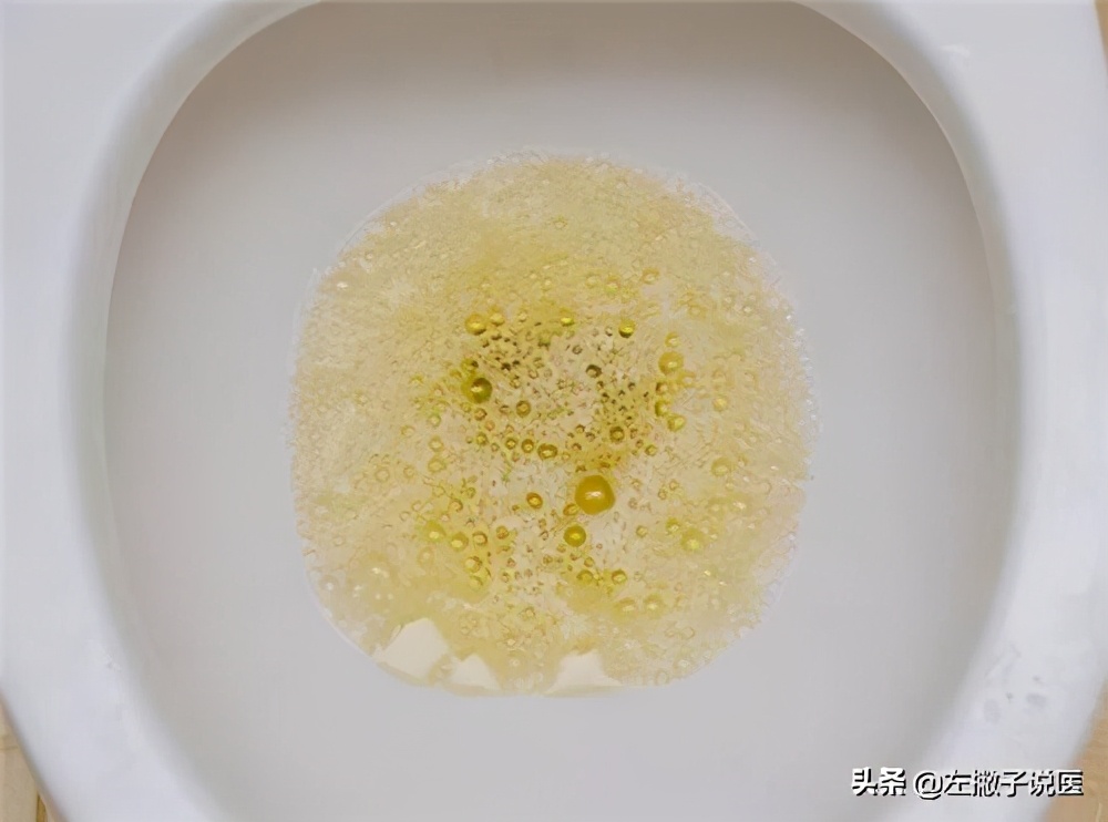 辟谣：尿液出现泡沫就是蛋白尿？一文跟你说清引起泡沫尿的原因