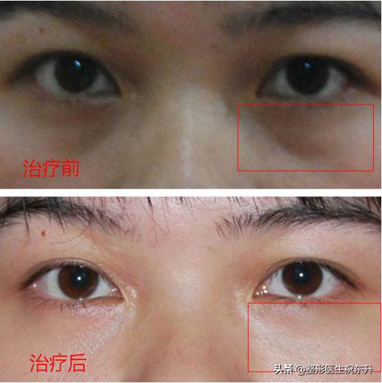 40多岁眼袋很重，还有泪沟该怎么办？听听医生怎么说...
