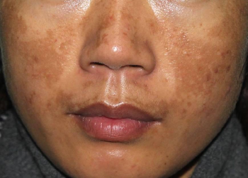 刷果酸能祛斑吗,果酸可以嫩肤吗