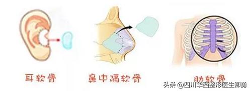 最常见的隆鼻材料有哪些,隆鼻材料有哪些如何选择隆鼻材料