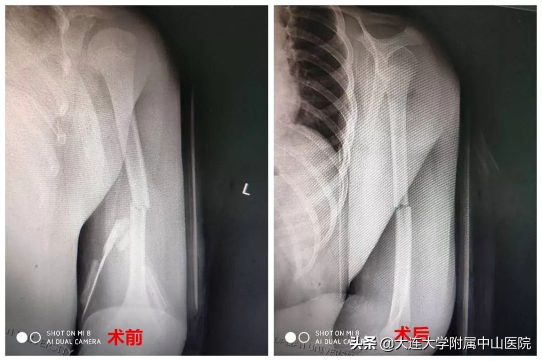 髋部骨折中西医诊疗,儿童骨损伤诊治康复