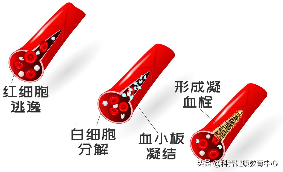 如何用红花油消退瘀青,摔伤淤青不消退是怎么回事