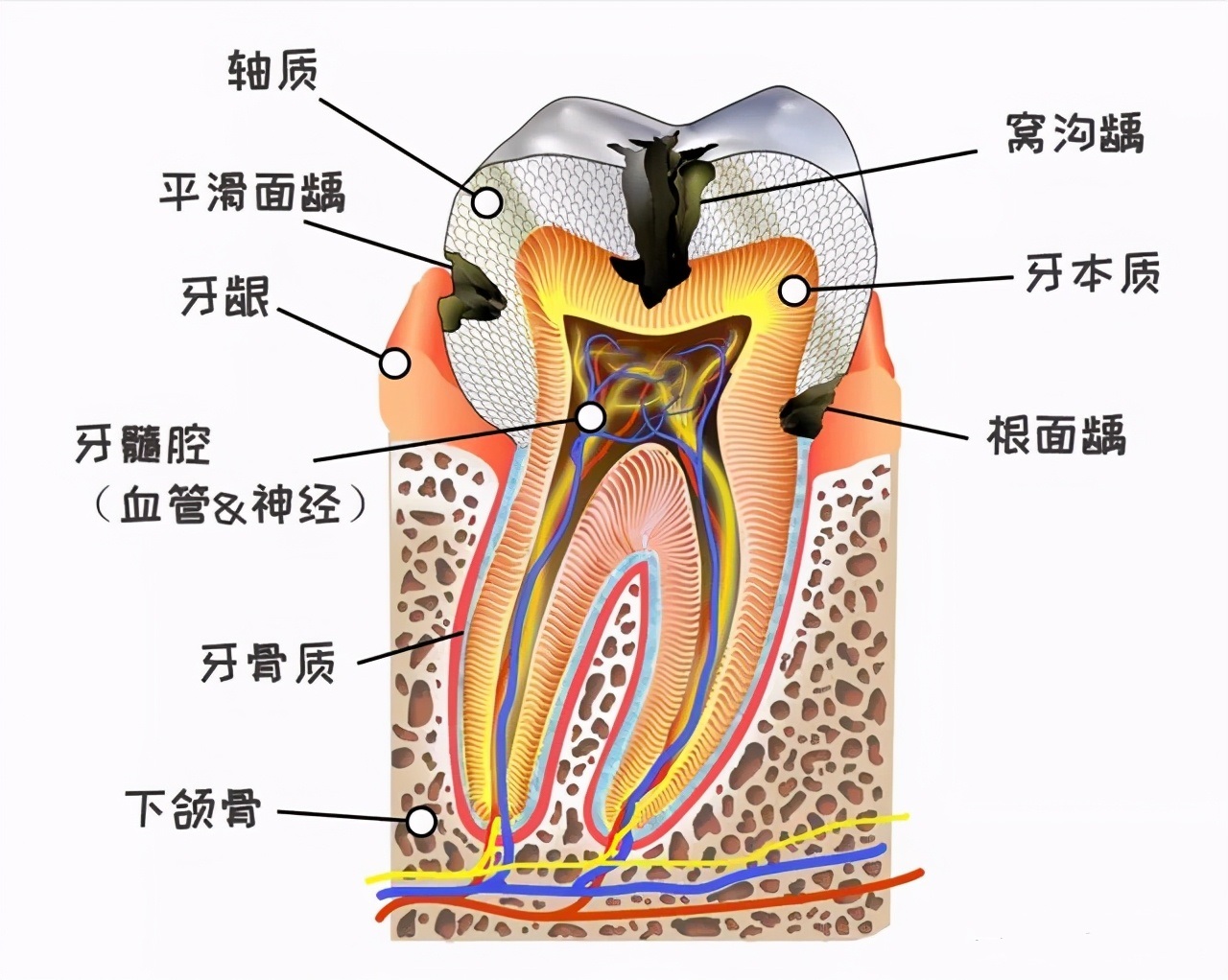 后槽牙有黑线怎么去除,牙沟上有黑线怎么办用什么刷