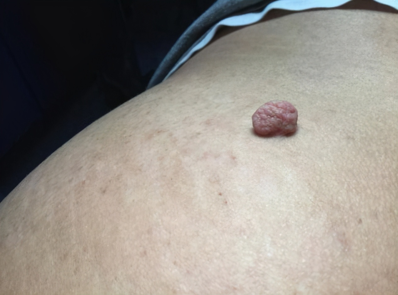 脖子腋下腹股沟长小肉粒怎么去除,腋下脖子上长小肉粒是什么原因