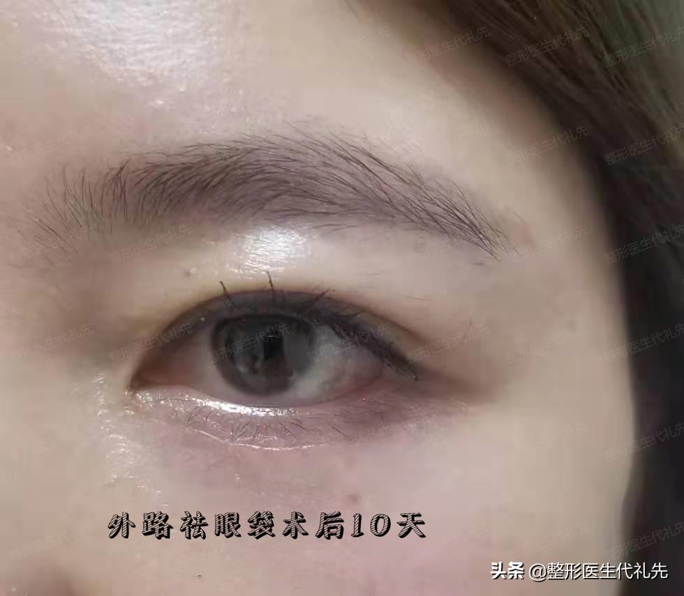 不开刀祛眼袋和开刀祛眼袋哪个好,微创祛眼袋和手术开刀哪种效果好