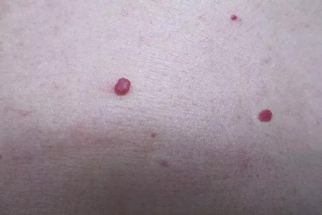 身上突然长咖啡色肉痣是咋回事,身上出现红色痣一定与肝脏有关吗