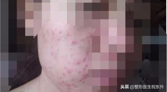 刚做完超声刀感觉脸有点肿正常吗,做完超声刀后脸肿了是正常现象吗