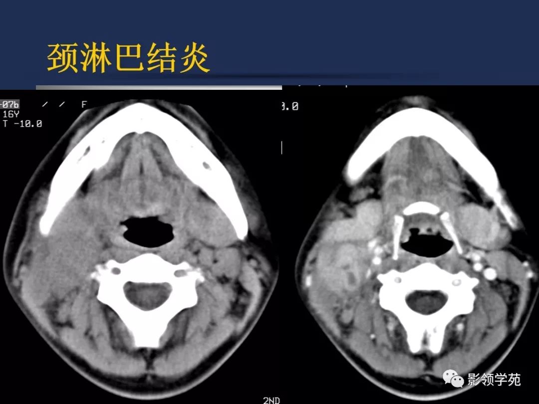腮腺疾病影像学诊断,腮腺肿块影像诊断