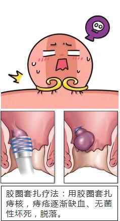 内痔疮便血脱肛怎么治疗好,痔疮便血怎么治疗最好
