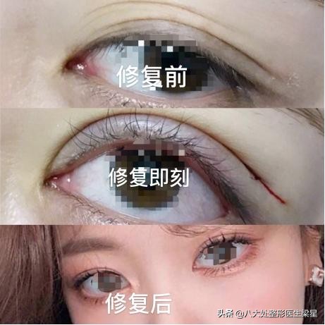 平行式双眼皮变成普通窄双眼皮了,悲伤蛙双眼皮图片