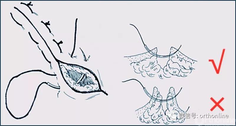 十种外科基本缝合方式详解,手术切口缝合有哪几种