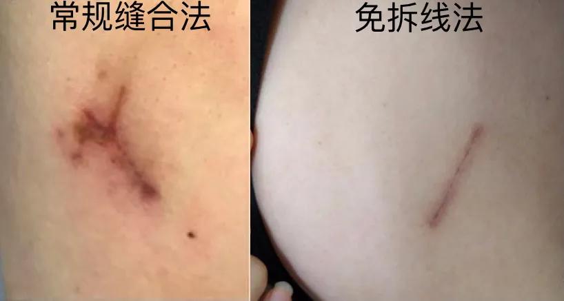 面部微创美容手术,面部免拆线美容缝合