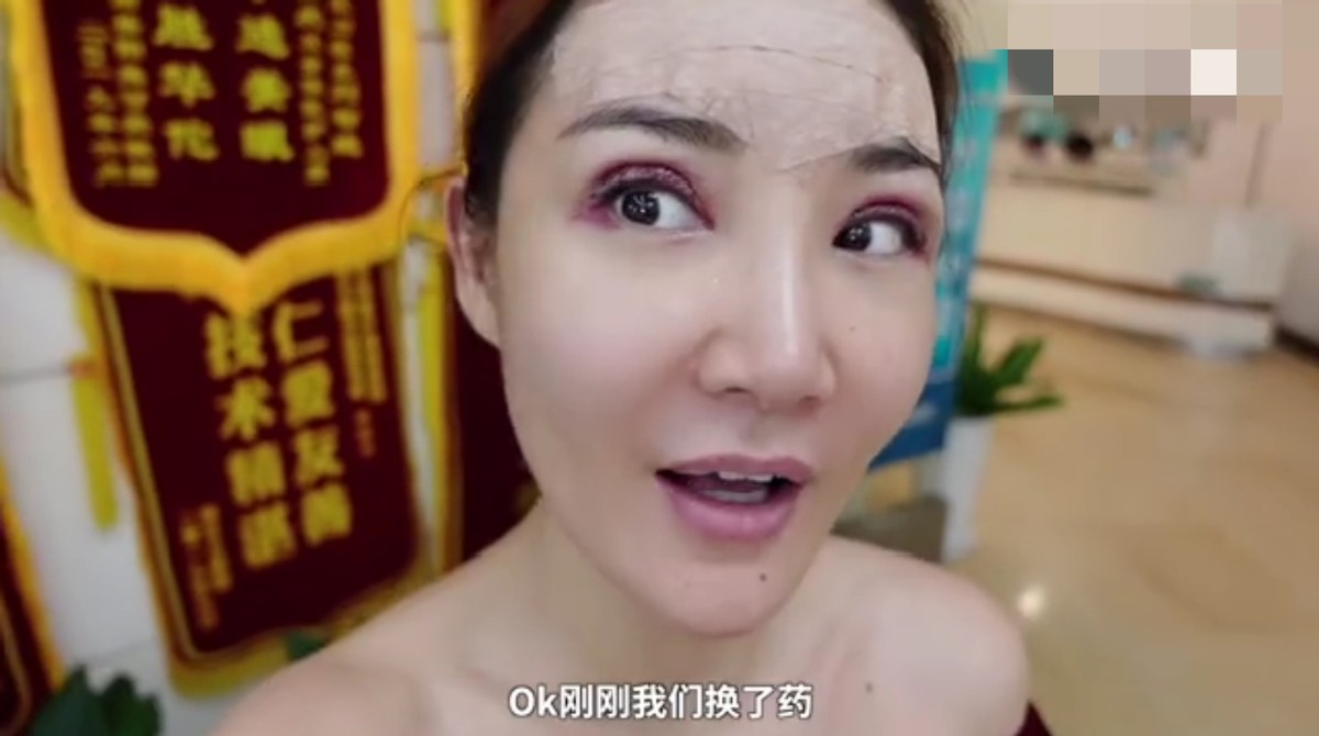 央视报道整容手术,女明星割双眼皮前后
