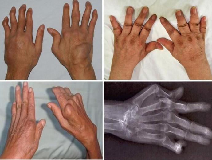 中医治“风湿性关节炎”1例,47岁,肝肾俱虚,双踝关节肿大