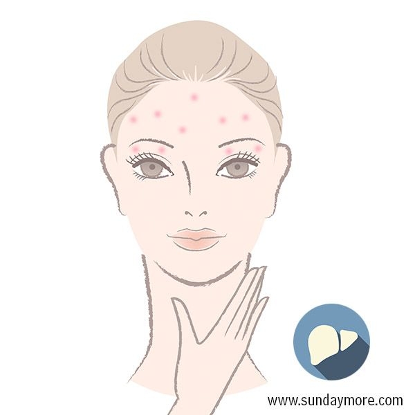 暗疮最好的消除方法 (暗疮印最佳治疗方法)