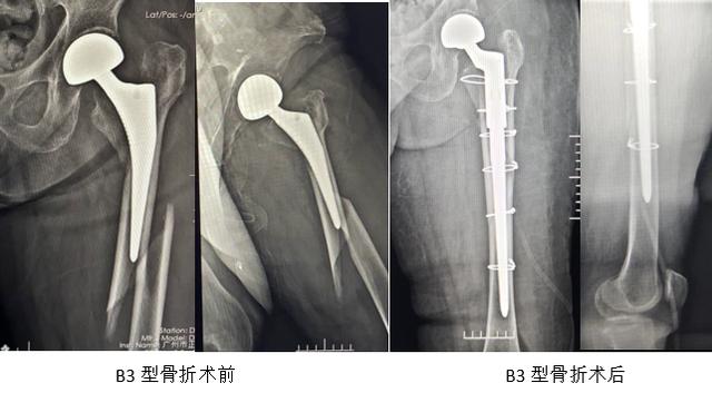 髋部骨折危害大老年人摔伤要重视,髋部骨折的最简单方法
