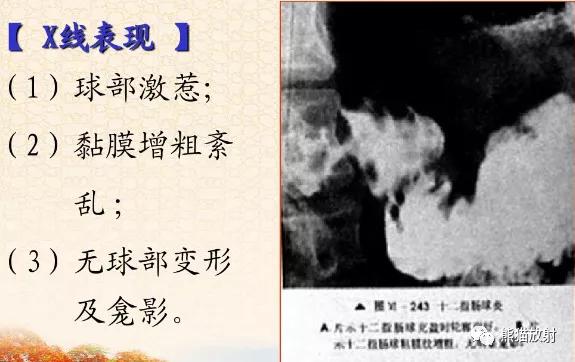 十二指肠球部溃疡解剖位置,十二指肠球部溃疡x线表现