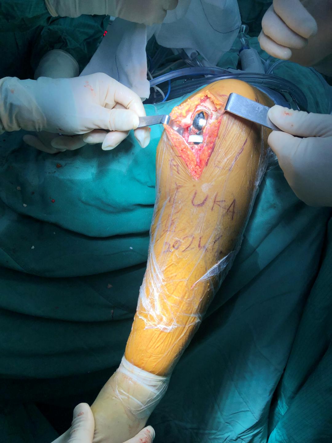 百色市人民医院关节外科开展膝关节单髁置换术,保膝技术再添“法宝”