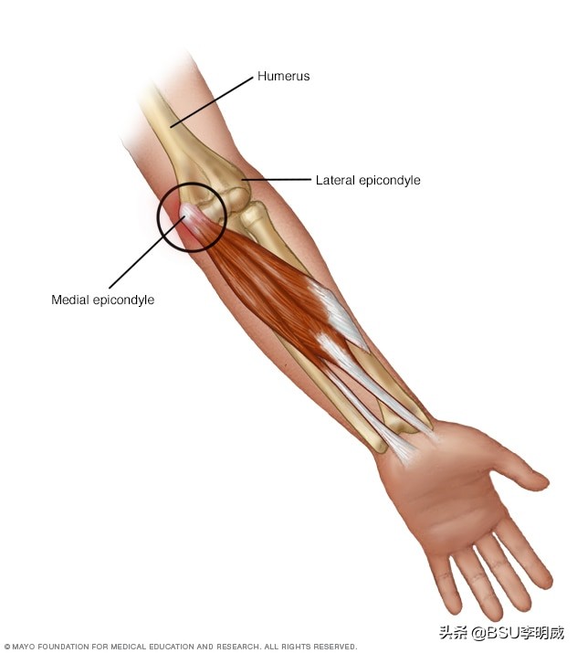 手肘疼怎么解决,劳累引起高尔夫球肘疼