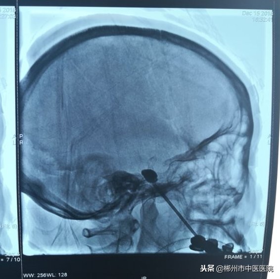 70多岁奶奶痛得连死的心都有，博士一针解决2万小时的痛不欲生