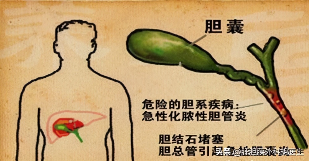 急性胆管炎应该怎么诊治,急性梗阻性化脓性胆管炎