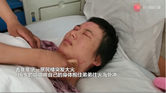 16岁女孩救弟弟严重烧伤,11岁少年救妹妹被火烧伤