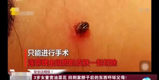 虫子叮咬引发疾病,虫子叮咬会得什么病