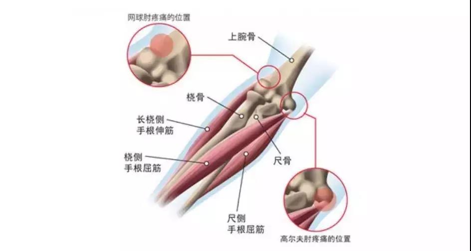 为什么不会打网球还能患上网球肘,不打网球的人会患上网球肘吗