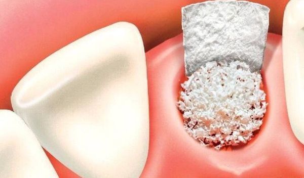 为什么有人做种植牙还需要植骨,植骨后多久可以戴义齿