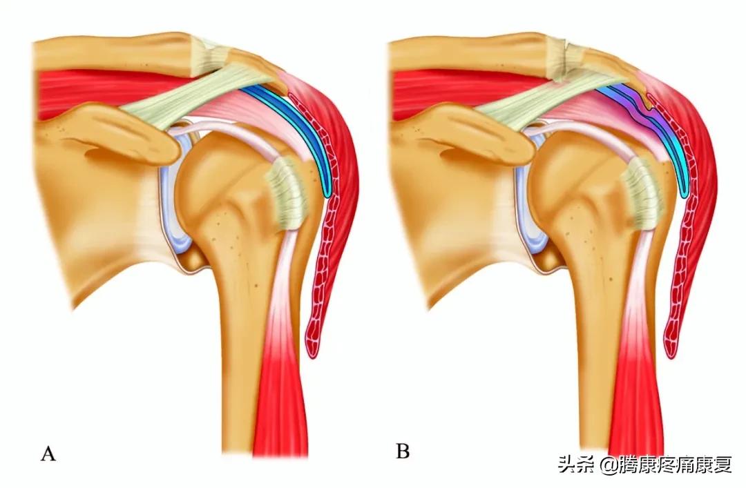 肩峰下撞击综合征的症状,肩峰下撞击综合征的机制是什么