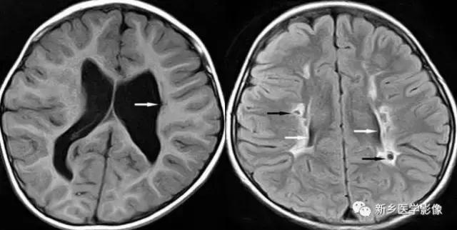 脑室为什么会扩张,脑室为什么会变小
