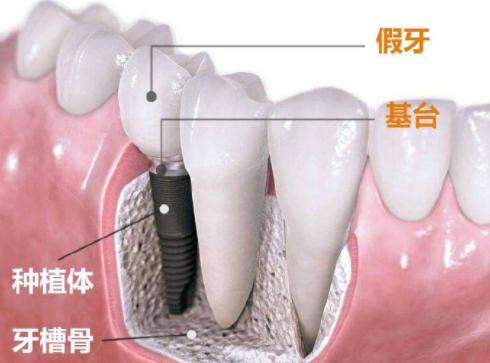 种植牙手术的全过程,种植牙真的10分钟就能种好