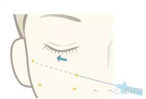 什么是线雕美容过程,什么是线雕眉