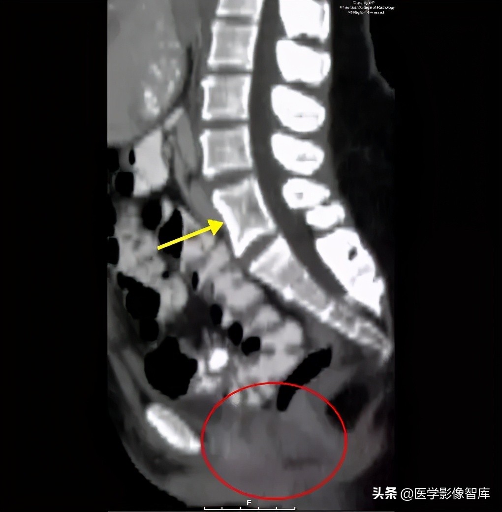 先天性无阴道综合征的影像诊断