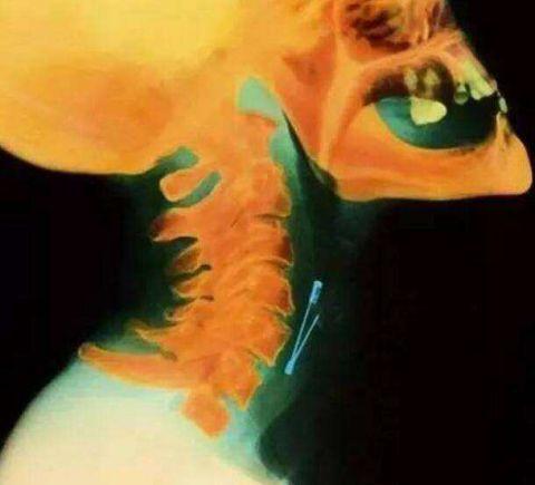 不作死就不会死,看看这些被人类搞进身体里的异物