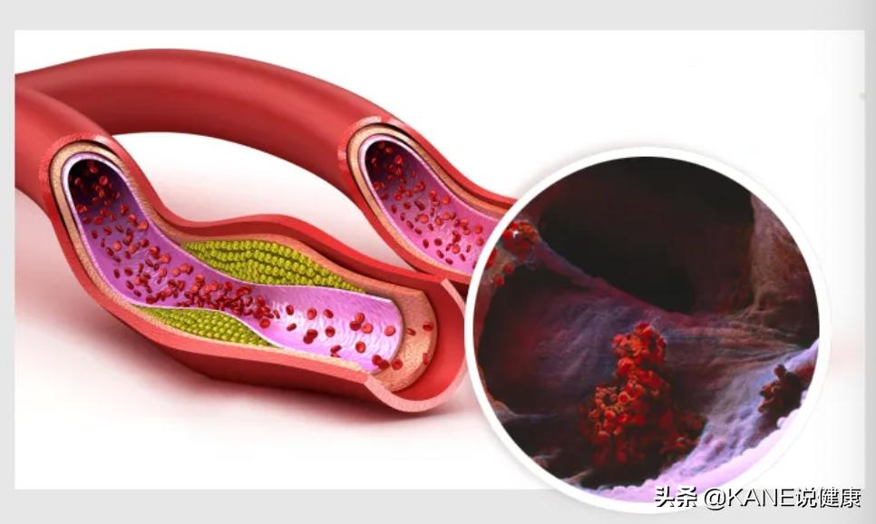 血液净化能控制血栓吗,血液净化真的能排油吗