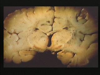 新生儿各种黄疸的鉴别和治疗,小孩黄疸不是病理性的怎么处理