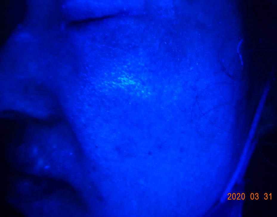 一位散发型白癜风患者的自白：坚持治疗能痊愈，千万别放弃自己