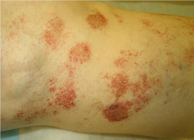 过敏性紫癜算是风湿病的一种吗,风湿性关节炎与过敏性紫癜区别