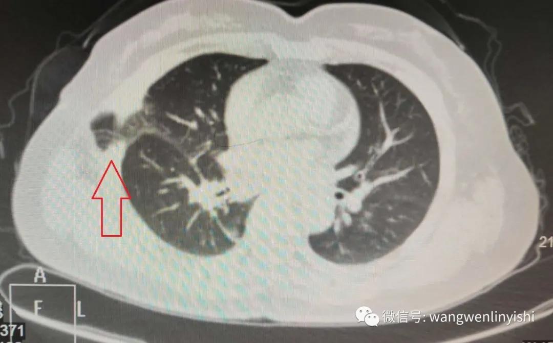腹腔镜下腹股沟疝修补术切口等级,腔镜下腹膜外疝修补术流程