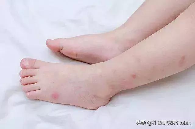 宝宝换季皮肤问题多妈妈怎么办,宝宝夏季皮肤问题